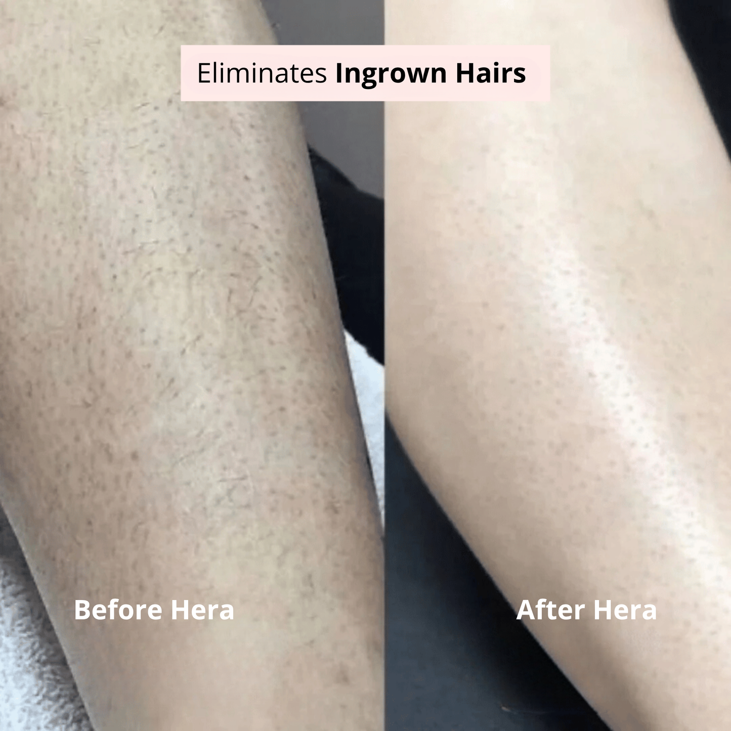 Irritation-free intimate razor