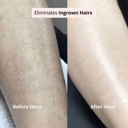 Irritation-free intimate razor