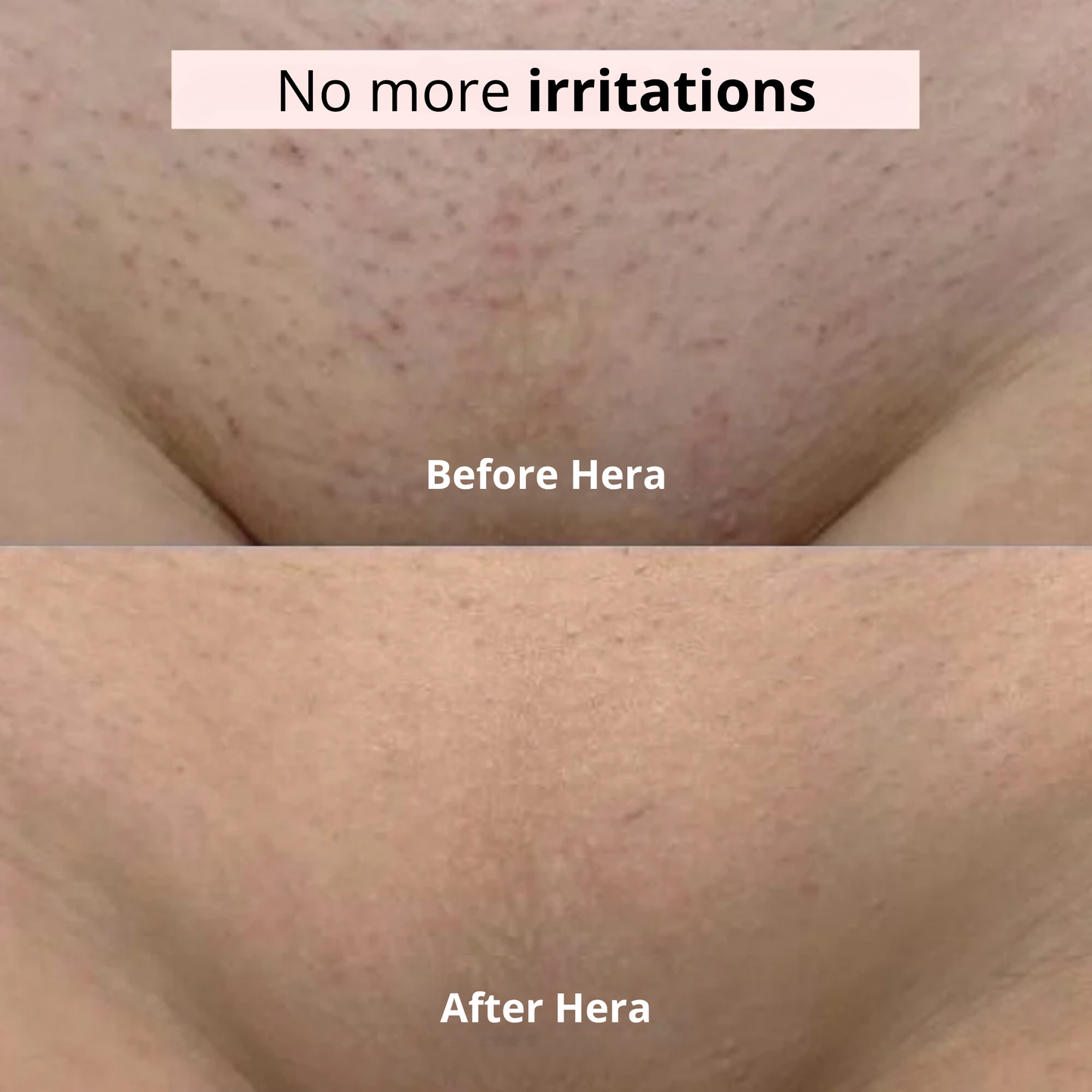 Irritation-free intimate razor